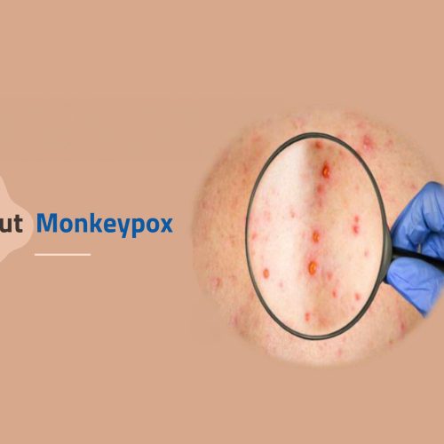 Monkeypox: What You Need to Know About This Emerging Health Threat
