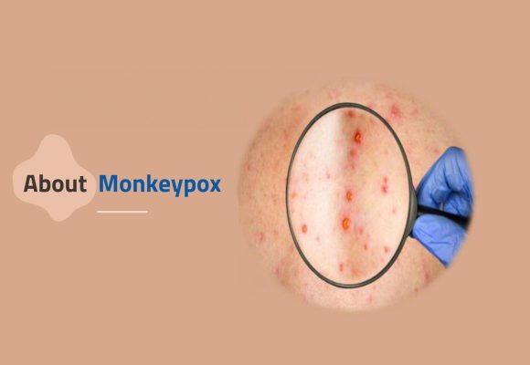 Monkeypox: What You Need to Know About This Emerging Health Threat