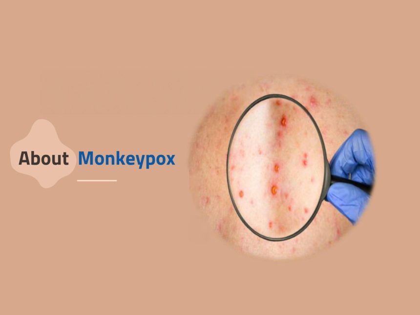 Monkeypox: What You Need to Know About This Emerging Health Threat